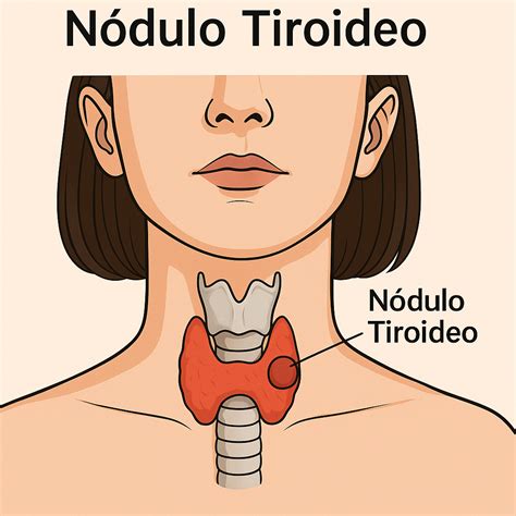 Nódulo Tiroideo y Cáncer de Tiroides en Concepción | Dr. Mario Tapia - Dr. Mario Tapia ...