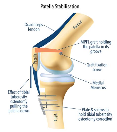 Knee dislocation surgery recovery time new arrivals