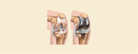 Amputation vs Limb Salvage: Understanding the Differences – Knya