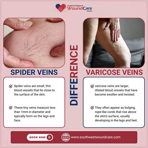 Spider & Varicose Veins in Lubbock, TX – Symptoms & Care