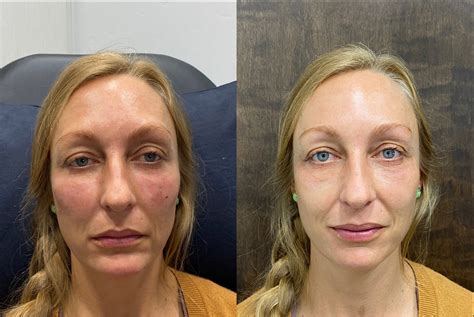 What Is A Botox Eyebrow Lift at Natalie Kelley blog