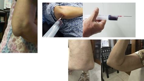 Image result for Elbow Cysts Explode