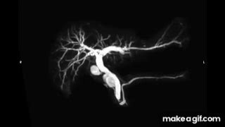 Image result for MRCP Biliary Tree
