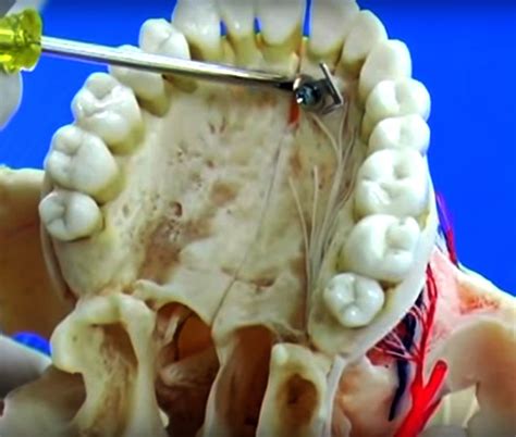 Extraoral Technique of Local Anesthesia 的图像结果
