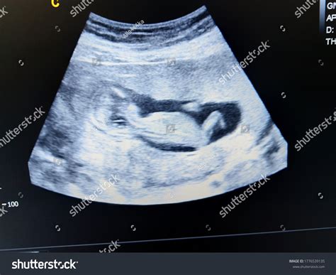 Fetus 14 Weeks By Ultrasound Scan库存照片1776539135 | Shutterstock
