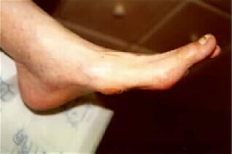 Diabetic Charcot Neuropathy - Foot & Ankle - Orthobullets