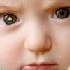 Cataract in children | Dr. Suma Ganesh