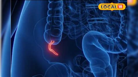 Appendicitis: 'अपेंडिक्स' म्हणजे पोटात नेमकं होतं काय? कशामुळे होतो हा ...