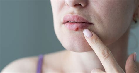 Cold Sore On Lip Line