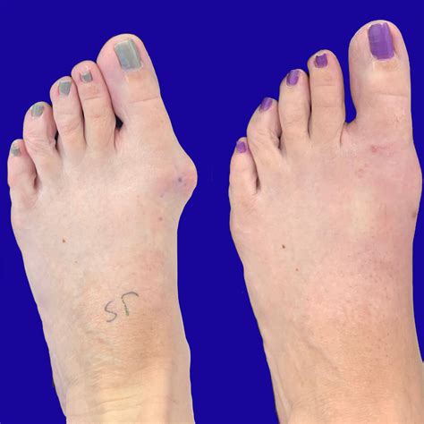 Foot Bunion Surgery Before And After at Hamish Geake blog