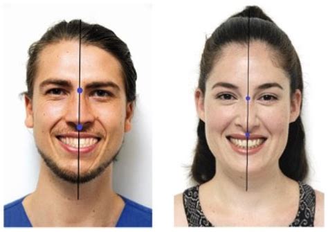 Impact of Dental Midline Shift on the Perception of Facial ...
