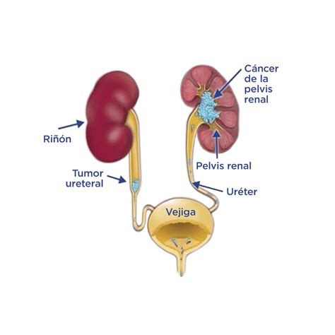 Carcinoma urotelial del tracto urinario superior (CUTUS): Guía del ...