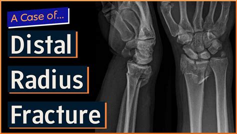 Image result for Distal Radius Fracture Recovery