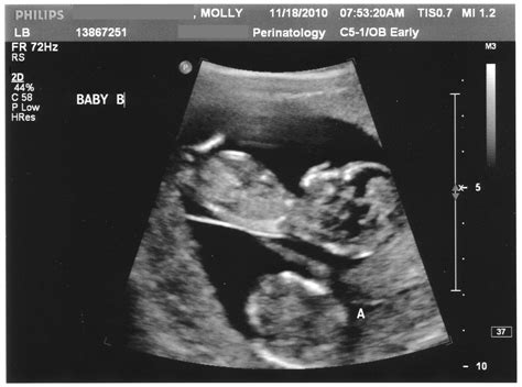 Nuchal Translucency Screening | Nuchal translucency, Human chorionic gonadotropin, First ultrasound