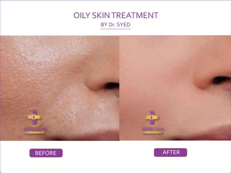 Oily Skin treatment in South Dlehi, Malviya Nagar - Dermatrico