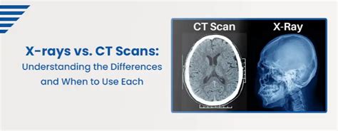 X-rays vs. CT Scans: Understand Differences
