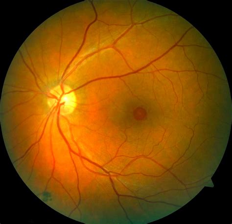Eye Diseases | Retina & Macula | Cataract & Glaucoma