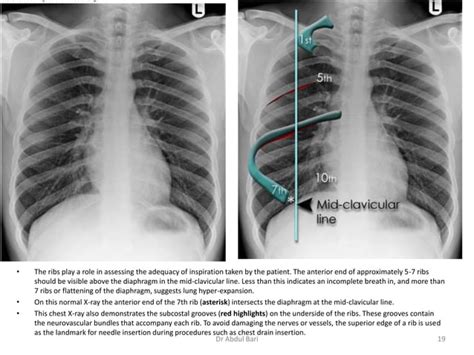 Image result for Chest X-Ray Tutorial
