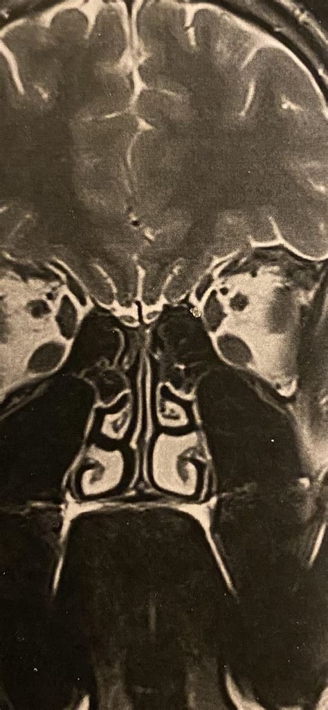 Are my turbinates swollen? : r/Sinusitis