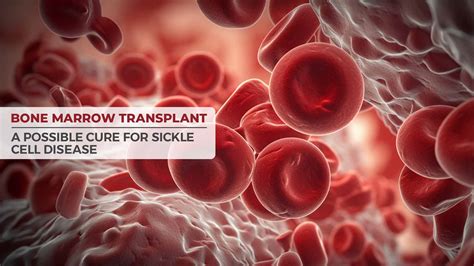 Advanced Bone Marrow Treatment for Sickle Cell Patients