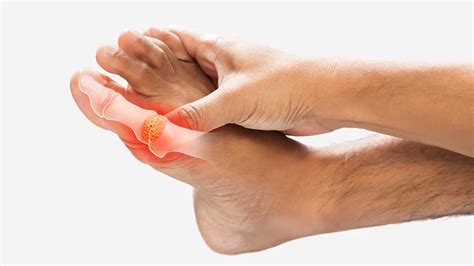 What Causes Gouty Arthritis? – NutritionFact.in