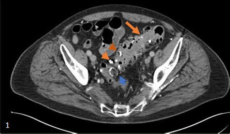 Image result for Colonic Diverticulum CT