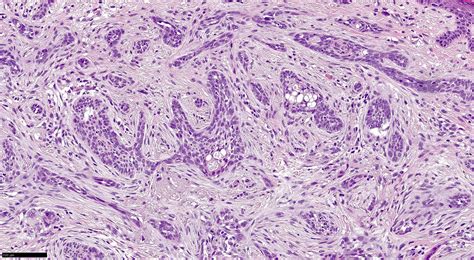 Squamous Cell Carcinoma Vs Basal Cell Carcinoma Histology