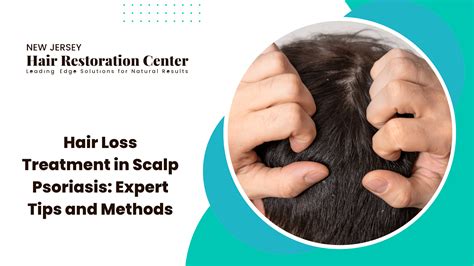 Hair Loss Treatment in Scalp Psoriasis: Expert Tips & Methods