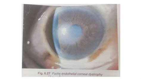 Fuchs endothelial corneal dystrophy.pptx