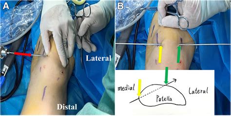 Reconstruction of the Medial Patellofemoral Ligament Through a Double ...