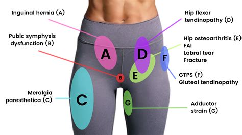 Hip Pain Location Diagram Female Guide