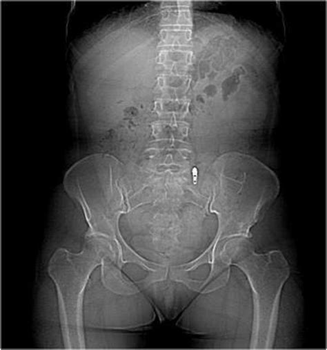 Migration Xray