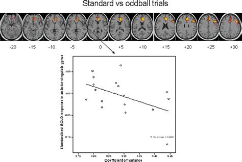 Temporal Lobe Dysfunction in Medication-Naïve Boys With Attention ...
