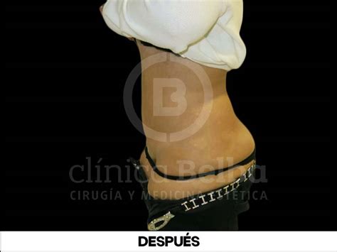 Abdominoplastia Antes y Después | fotos reales 】© BELBA