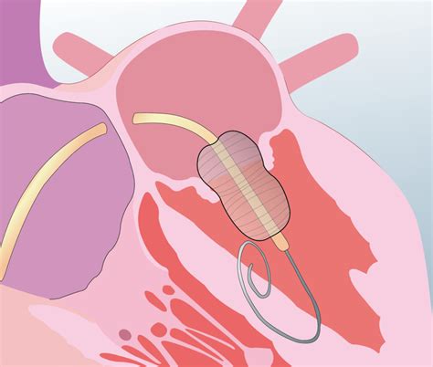TAVI Procedure Pune | Structural Heart | Dr. Purvez Grant