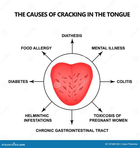 Disease Of The Tongue Cartoon Vector | CartoonDealer.com #78947545