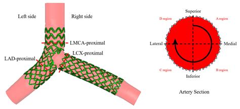 Applied Sciences | Free Full-Text | Restenosis Investigation of Two-Stent Placement in the ...