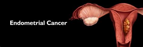 Endometrial cancer: Causes, Symptoms, Diagnosis & Treatment