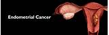 Endometrial cancer: Causes, Symptoms, Diagnosis & Treatment