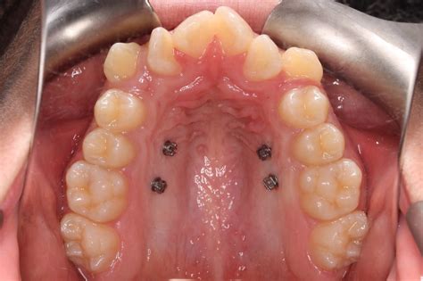 Palatal Expanders: Why, How, and When