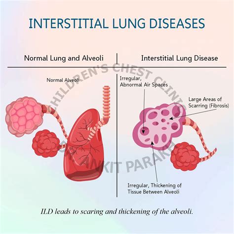 7 Diffuse Parenchymal Lung Disease Thoracic Key Parenchymal Lung