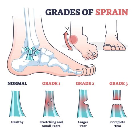 What is an ankle sprain? | Orthopaedics Toronto - OrthoTO