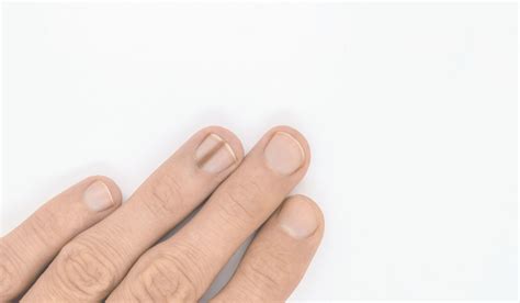 Discovering the truth about nail matrix melanomas