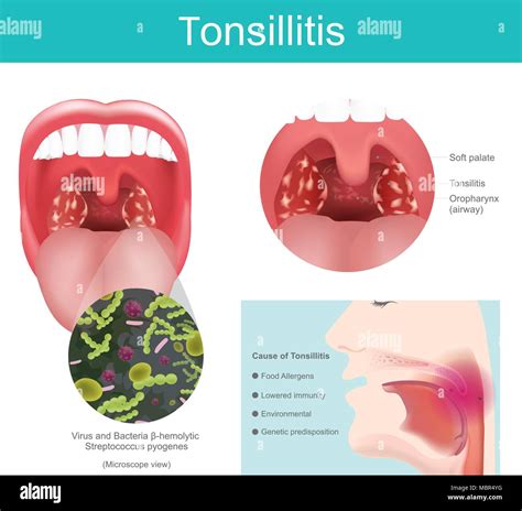 Bacterial Tonsillitis Tongue