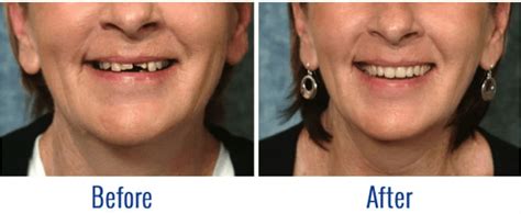 Image result for Immediate Dentures Procedure