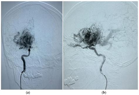 Associations of Brain Arteriovenous Malformation-Related Factors with ...