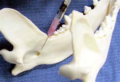 Local Anesthesia Blocks 的图像结果