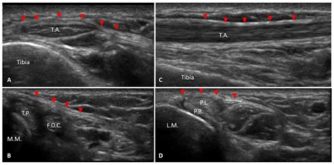 Ultrasound Imaging of Ankle Retinacula: A Comprehensive Review