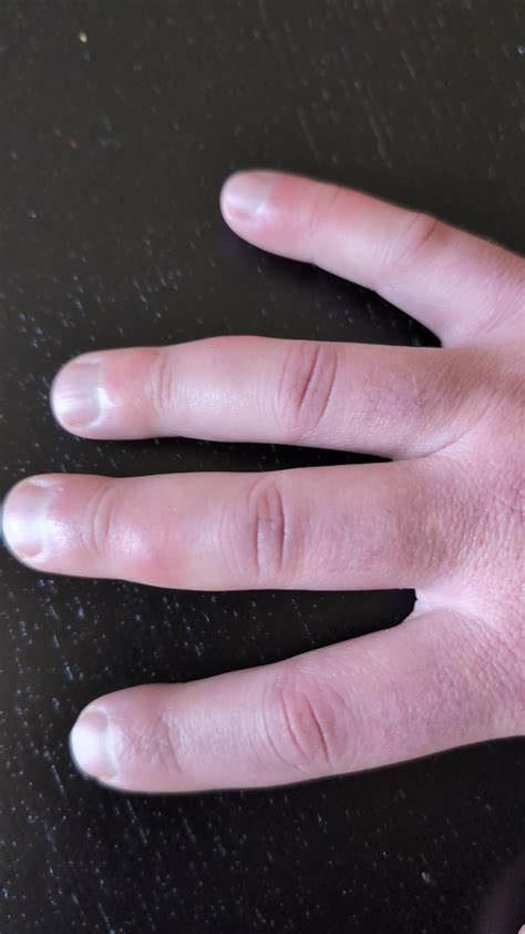 Swelling, numbness, bumps on fingers : r/medical