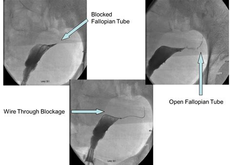 Image result for Fallopian Tube Replacement Surgery